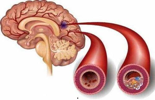 脑梗病人可以吃狼瓜吗米,狼瓜的适宜性探讨